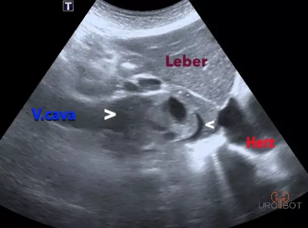 Tumorthrombus Vena cava - Uro-Bot.de
