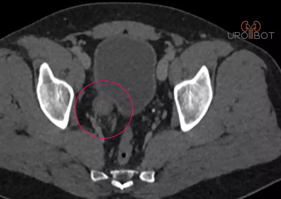 CT Aufnahme eines Harnleitertumors - Uro-Bot.de