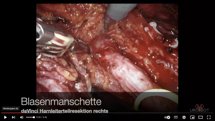 daVinci Video Blasenmanschette - Uro-Bot.de