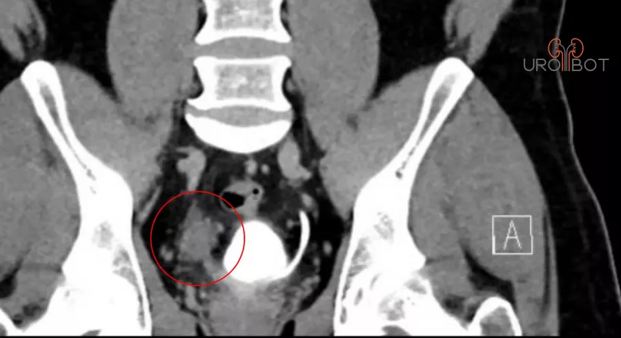 CT Aufnahme eines Harnleitertumors - Uro-Bot.de