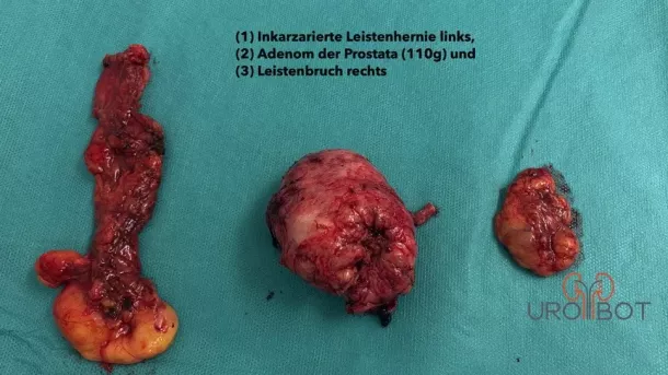 Leistenbruchinhalt und innerer Prostataanteil - Uro-Bot.de